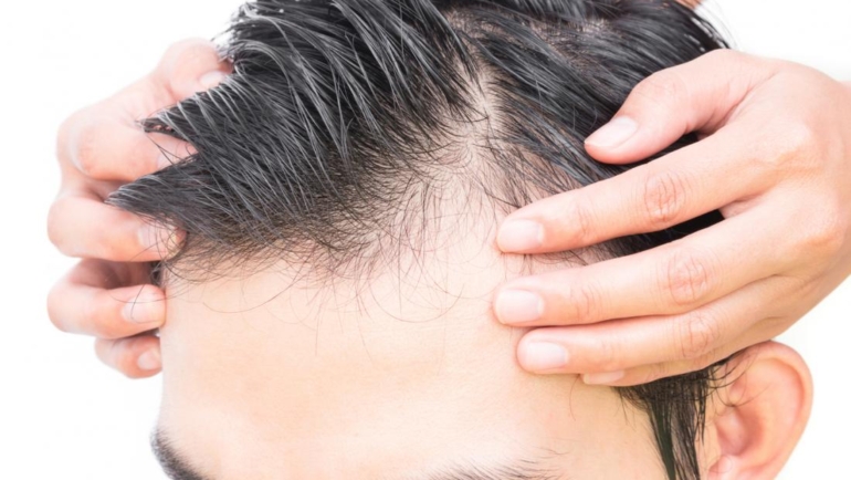 Functional Causes of Hair Loss in Men