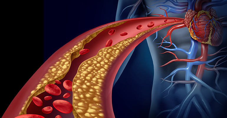 Restore Your Blood Vessel Health with Plaquex
